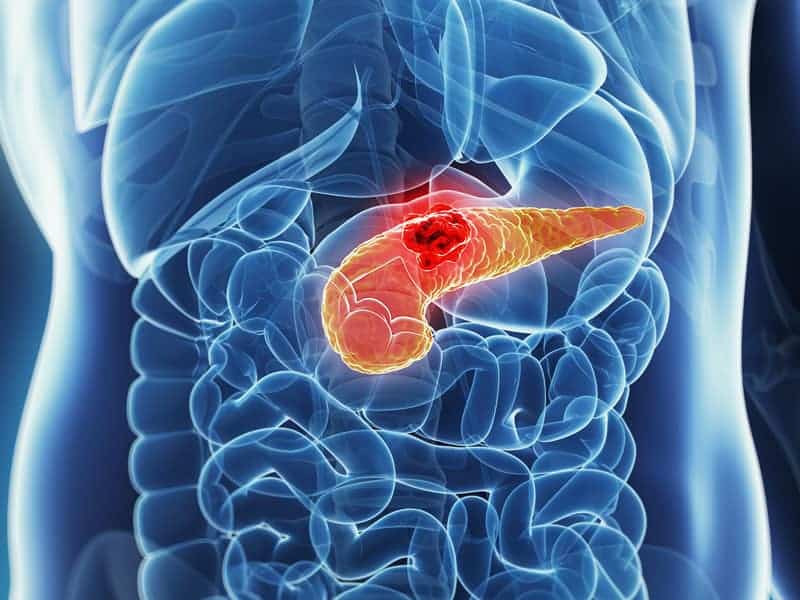Disparities in Pancreatic Cancer Treatment