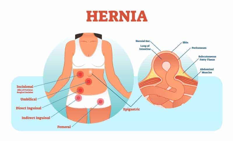 Hernia’s – A Quick Guide